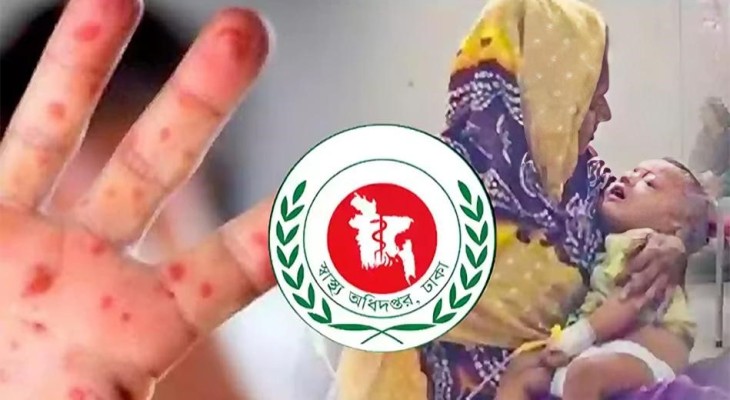 আরও ৪ শিশুর মৃত্যু, ৯৪ দিনে হাম ও উপসর্গে মৃত ৬৬১